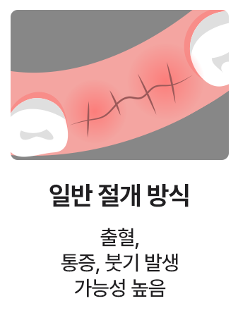 일반 절개 방식